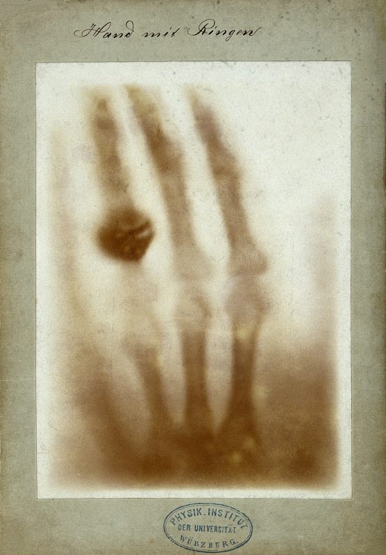 The first x-ray by Wilhelm Röntgen of the left hand of Anna Röntgen, 1895